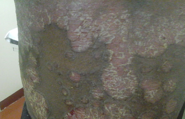 Psoriasis Psoriasis