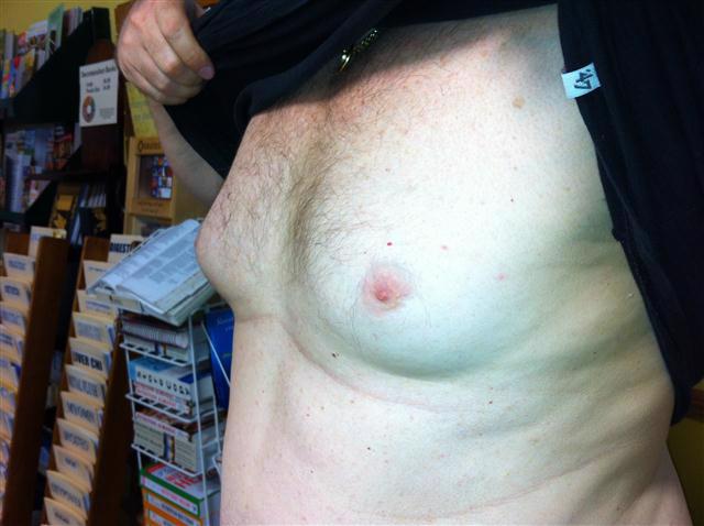 Gynecomastia in Prostate Cancer Patient
